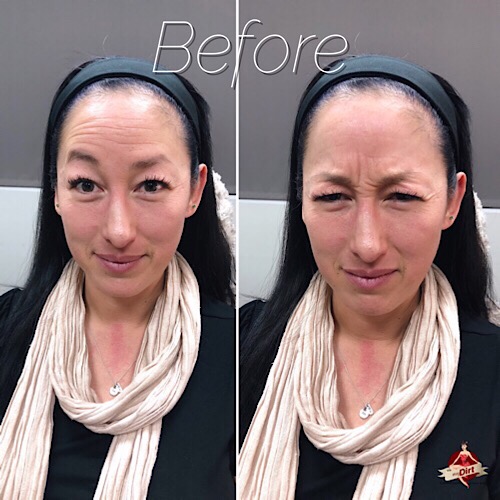before pictures facial fillers