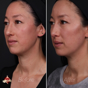 before and after facial fillers