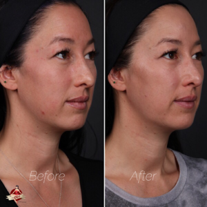 facial fillers before and after
