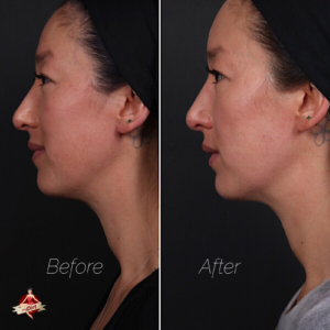 facial filler before and after photos