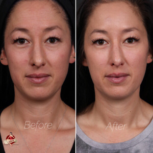 7 things I learned having facial fillers for the first time