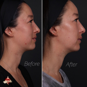 7 things I learned having facial fillers for the first time